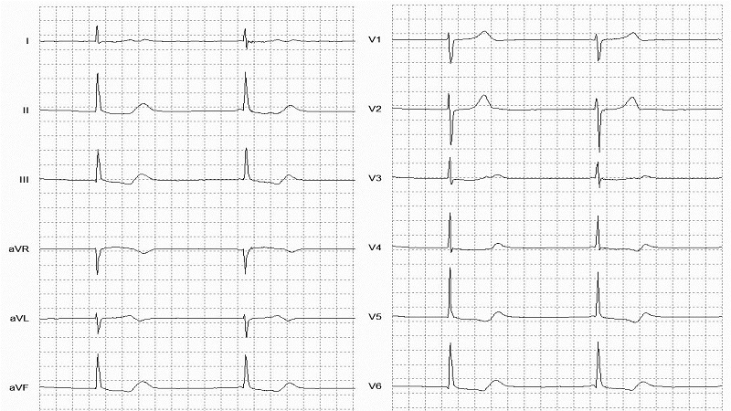 Nodal (A-V junctional) rhythm 12 Lead EKG